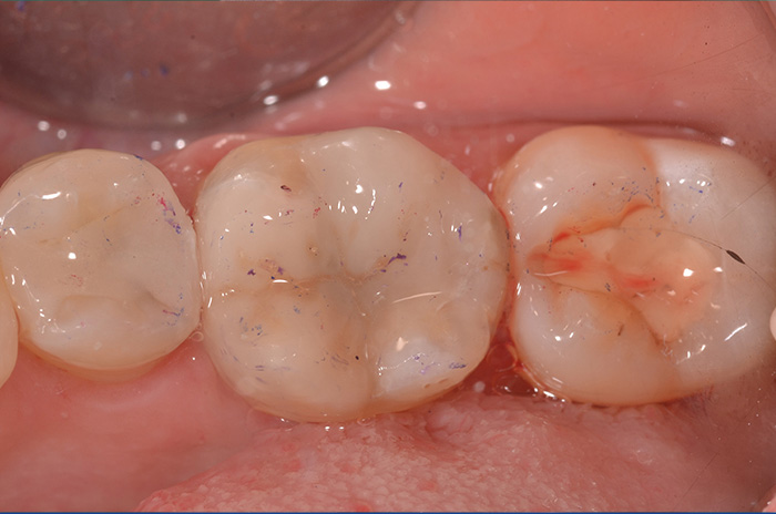 intarsio cementato occlusale