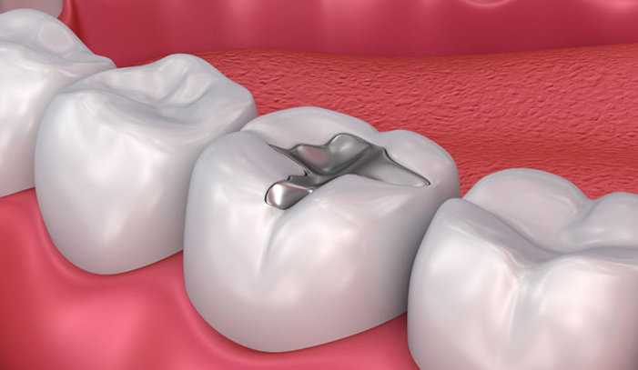 Amalgama dentale