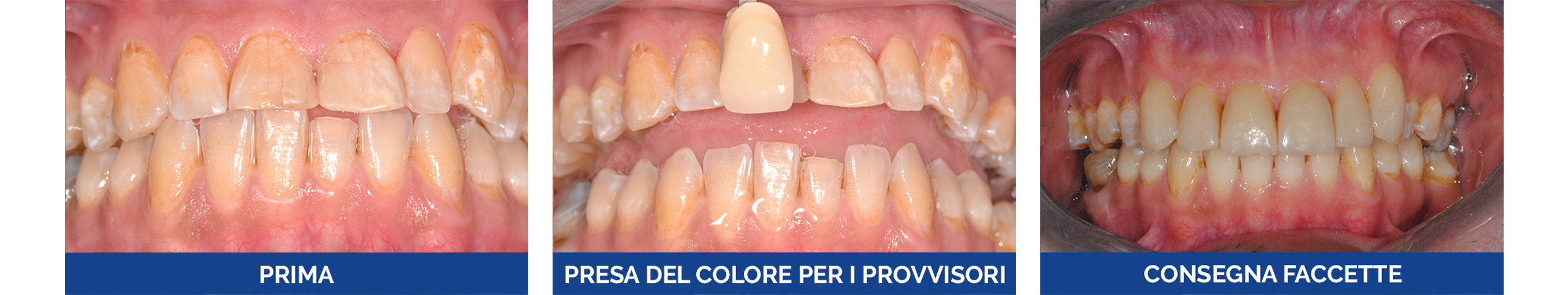 Faccette dentali