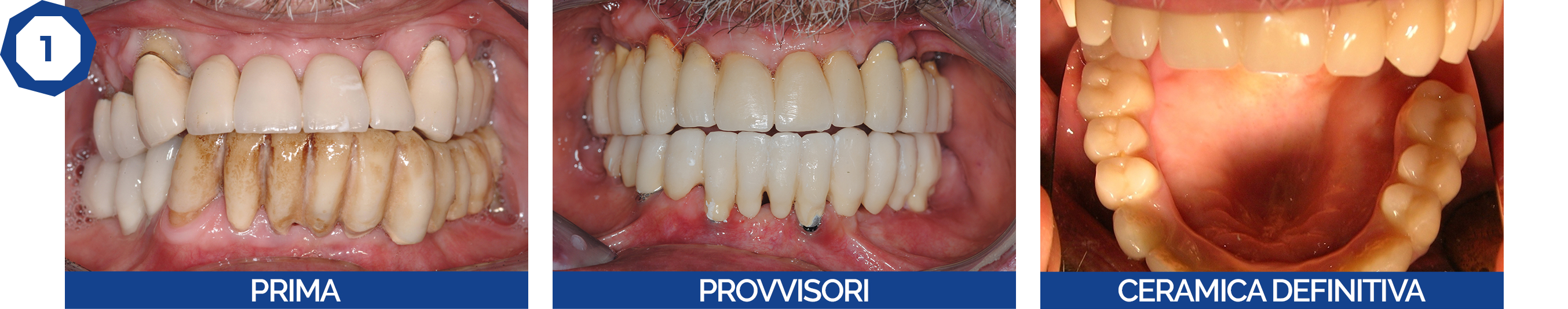 Caso clinico Implantologia