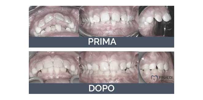 Caso clinico ortodonzia 3