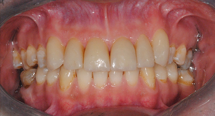 faccette-estetiche-consegna