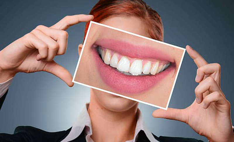 Sbiancamento dentale Roma Prati